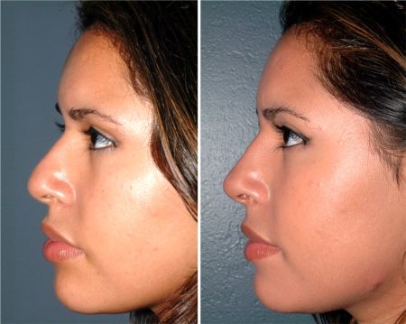 How much does nose job surgery cost?